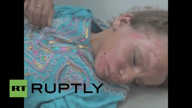 Not Gaza, Yemen. Imagine the response if Iranian jets were inflicting these wounds upon Saudi children.