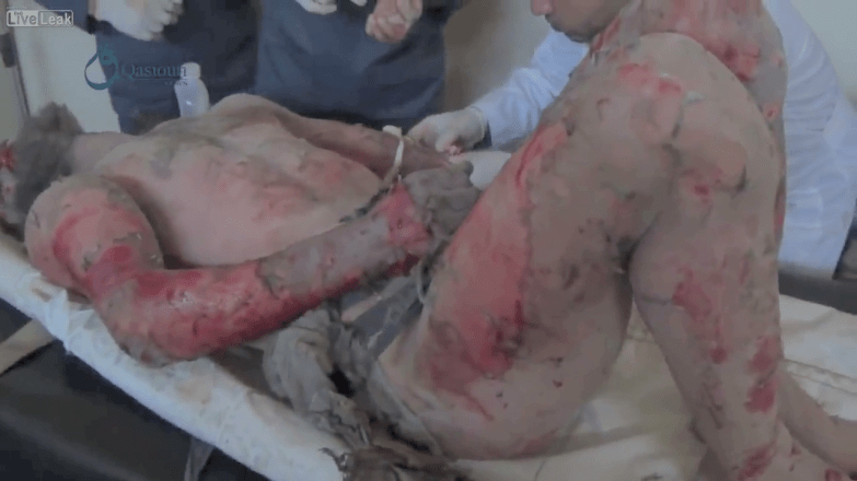 Horiific wounds. Syrian insurgent has had his clothes burned and blown off.